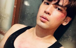 陳零九分手2個月！才感慨「每天離死亡更近」　竟遇追撞車禍臉部爆血